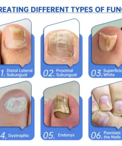 QIAWI™ PureNail Fungus Laser Device